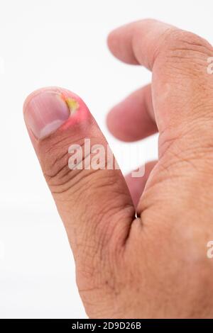 Serie von schmerzhaften Fingernagel Haut Infektion mit Eiter reatment Stockfoto