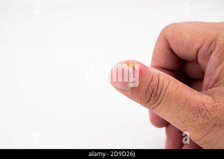 Serie von schmerzhaften Fingernagel Haut Infektion mit Eiter reatment Stockfoto