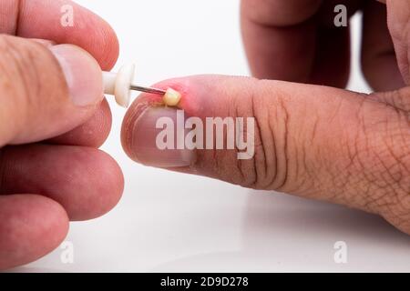 Serie von schmerzhaften Fingernagel Haut Infektion mit Eiter reatment Stockfoto