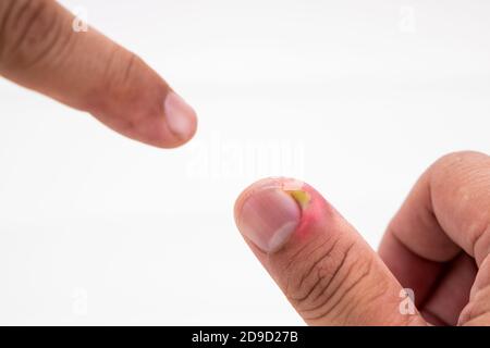Serie von schmerzhaften Fingernagel Haut Infektion mit Eiter reatment Stockfoto