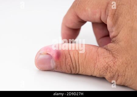 Serie von schmerzhaften Fingernagel Haut Infektion mit Eiter reatment Stockfoto