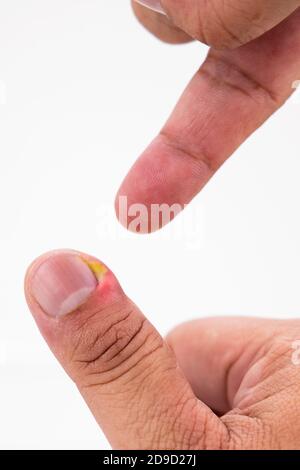 Serie von schmerzhaften Fingernagel Haut Infektion mit Eiter reatment Stockfoto