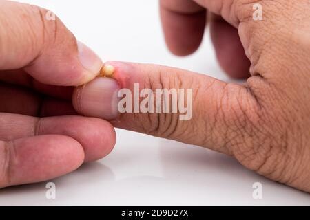 Serie von schmerzhaften Fingernagel Haut Infektion mit Eiter reatment Stockfoto