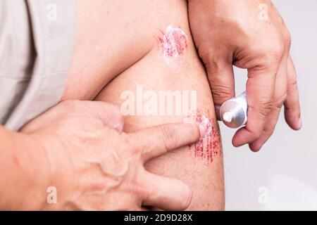 Person, die antiseptische Creme auf schmerzhafte Wunde Stockfoto