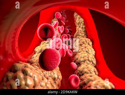 Cholesterinbildung, Fett, Arterie, Vene, Herz. Rote Blutkörperchen, Blutfluss. Verengung einer Vene für die Fettbildung. Operation, 3d-Rendering Stockfoto