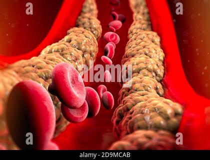 Cholesterinbildung, Fett, Arterie, Vene, Herz. Rote Blutkörperchen, Blutfluss. Verengung einer Vene für die Fettbildung. Operation, 3d-Rendering Stockfoto