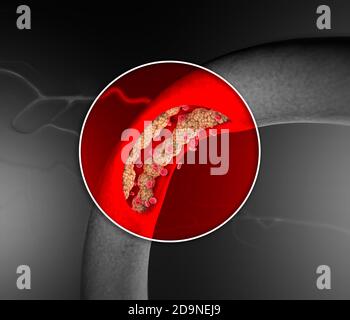 Cholesterinbildung, Fett, Arterie, Vene, Herz. Rote Blutkörperchen, Blutfluss. Verengung einer Vene für die Fettbildung. Operation, 3d-Rendering Stockfoto