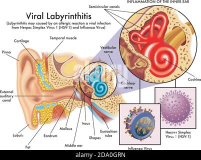 Eine Illustration eines entzündeten Innenohrs, das durch den Herpes simplex oder ein Influenza-Virus verursacht wird. Stock Vektor