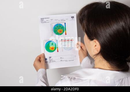 Dünner werdendes Hornhautdystrophie, Augen-Keratotopographie. Stockfoto