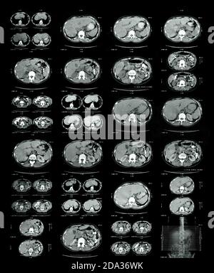 Magnetresonanz Bild der Fusion von Brust und Brustwirbelsäule Stockfoto