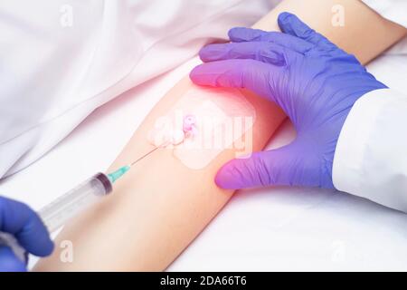 Ein Arzt legt einem Patienten einen Venenkatheter zur Injektion von Medikamenten in eine Vene, Nahaufnahme. Blutkreislauf-Krankheit Stockfoto