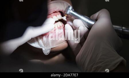 Junge Frau Zahnarzt. Empfang beim Kieferorthopäden. Austausch der Zahnspangen. Polieren. Gelverklebung. Stockfoto