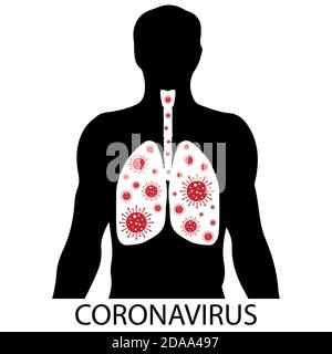 Virenquarantäne. MERS-Cov Middle East Respiratory Syndrome. Menschliche Lungen, die mit dem Virus infiziert sind. Atmungssystem. Krankheit innerhalb einer Person Stock Vektor