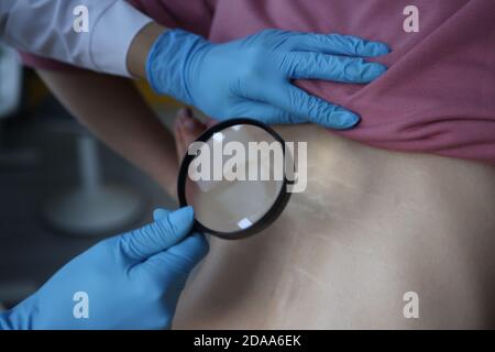 Arzt in Gummihandschuhen Untersuchung Dehnungsstreifen auf der Haut des Patienten zurück. Dermatologe hält Lupe in den Händen Stockfoto