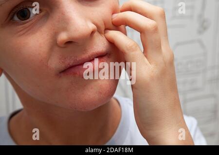 Atopische Haut auf dem Gesicht des Jungen. Menschliche Haut, eine allergische Reaktion, allergischer Ausschlag auf Gesicht und Lippen. Gesundheitswesen und Medizin Konzept. Stockfoto