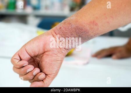 Ekzem am Handgelenk eines Mannes. Ekzem ist eine Entzündung der Haut, die Abschuppung, Juckreiz und die Entwicklung von kleinen Blasen verursacht. Sie kann durch verursacht werden Stockfoto