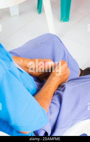 Nahaufnahme amputierte Hände des alten Mannes, der an Lepra leidet. Stockfoto