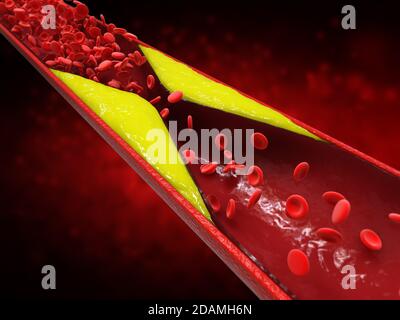 3d-Rendering Atherosklerose mit Cholesterinblut oder Plaque im Gefäß Ursache der koronaren Herzkrankheit Stockfoto