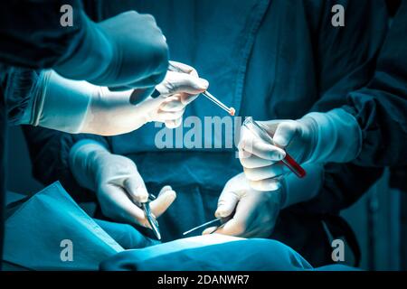 Konzentrierter professioneller chirurgischer Arzt Team Operation Chirurgie ein Patient im Operationssaal im Krankenhaus. Tumor Krebs. Chirurgische Biopsie Proben. Stockfoto