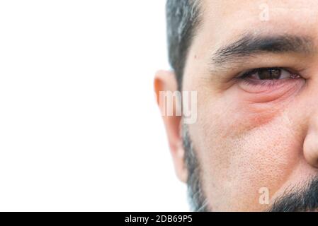 Mann mit schweinestall im Auge mit Platz für Text kopieren Stockfoto