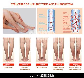 Thrombophlebitis. Thrombose Der Tiefen Vene. Krampfadern. Phlebeurysm. Struktur der normalen Venen und ungesunden Vene Stockfoto