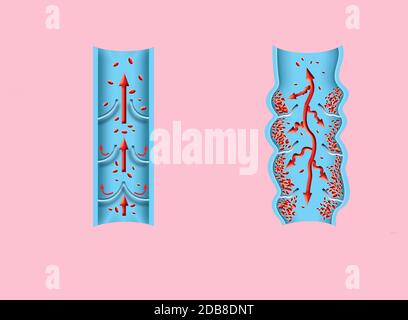 Thrombose. Von den normalen Blutfluss zu Blutgerinnsel und Blutgerinnsel, die durch den Blutstrom reist. Embolie. Abbildung für Biologische, medi Stockfoto