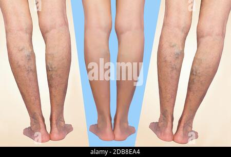Behandlung von Krampfadern vor und nach. Krampfadern an den älteren weiblichen Beinen. Stockfoto