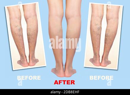 Behandlung von Krampfadern vor und nach. Krampfadern an den älteren weiblichen Beinen. Stockfoto
