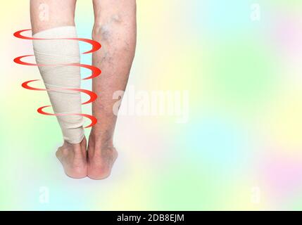 Die weiblichen Beine. Krampfadern. Phlebeurysm. Thrombophlebitis und elastische Bandage Stockfoto