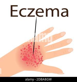 Ekzem betroffen eine hand Dermatologie Haut Krankheit Konzept Vector Illustration auf weißem Hintergrund Stockfoto