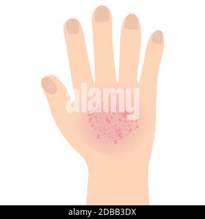 Ekzem betroffen eine hand Dermatologie Haut Krankheit Konzept Vector Illustration auf weißem Hintergrund Stockfoto