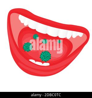 Viren bakterielle Überwuchsbildung im Mund. Grippe, Kälte, ansteckende Krankheit Vektor-Illustration auf weißem Hintergrund Stockfoto