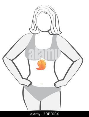 Gastroösophageale Refluxkrankheit. Gastritis Sodbrennen Gerd Magen in einem menschlichen Körper Vektor-Illustration auf weißem Hintergrund Stockfoto