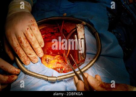 Ärzte führen Operation ist Mitralklappenersatz Operation auf offen Herz Stockfoto