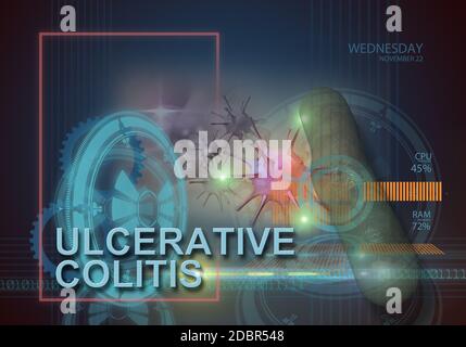 hi-Tech Infografiken von Colitis ulcerosa in 3d-Software hergestellt Stockfoto