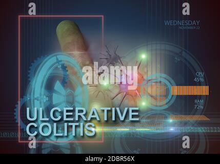 hi-Tech Infografiken von Colitis ulcerosa in 3d-Software hergestellt Stockfoto