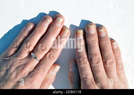 Pilznagelinfektion, Onycholyse nach Schellack oder Gellack auf weißem Hintergrund Stockfoto