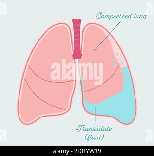 Hydrothorax - anatomisches Schema im handgezeichneten Stil. Akkumulation von transudataler Flüssigkeit in der Pleurahöhle, Art des Pleuraerguss Stock Vektor