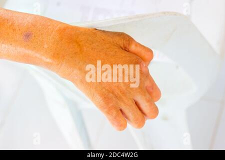 Nahaufnahme Hand von alten Mann an Lepra auf der Rückenlehne von Kunststoff-Stuhl leiden. Stockfoto