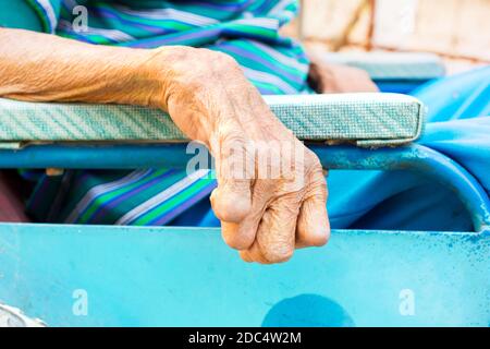 Nahaufnahme Hand des alten Mannes, der an Lepra leidet, amputierte Hand, auf Rollstuhl Stockfoto