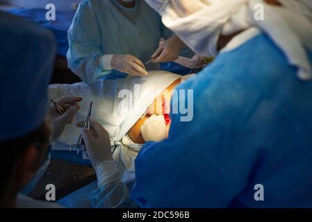 Chirurgie. Der Assistent des Chirurgen bindet die Ligatur über die Haut. Medizinische Intervention. Stockfoto