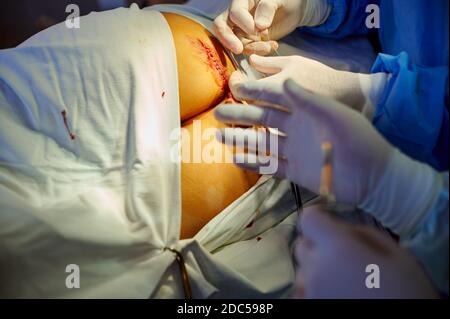 Chirurgie. Ansicht der Hände des Chirurgen, der die Ligatur bindet. Die Wunde nähen. Stockfoto