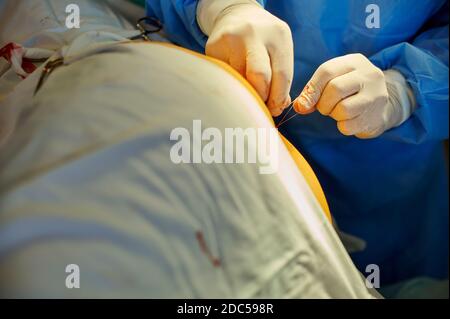 Chirurgie. Der Arzt bindet eine Ligatur an die Wunde. Stockfoto