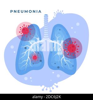 Coronavirus Pneumonie und illustrierte Lungen Vektor-Illustration Stock Vektor