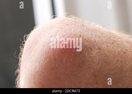 Frische reife Pickel auf einem mans Ellbogen. Ungesunde Haut. Stockfoto