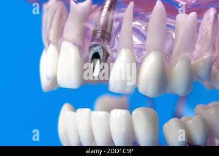 Zahnimplantat Schraube in menschlichen Kiefer Zähne Modell Stockfoto