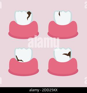 Zähne mit Hohlräumen - Vektordarstellung Stock Vektor