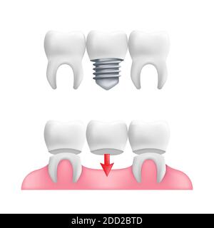 Prothesenkonzept - gesunde Zähne mit festen Zahnbridgearbeit und Implantaten. Vektordarstellung von menschlichen Zähnen in einem 3d realistischen Stil isoliert auf einem wh Stock Vektor