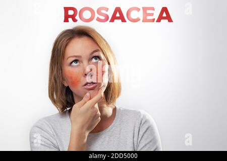 Medizin, Kosmetologie, Rosacea. Die Frau ist blond mit entzündeten Rosacea Wangen und Blutgefäßen. Text 'Rosacea', weißer Hintergrund. Stockfoto