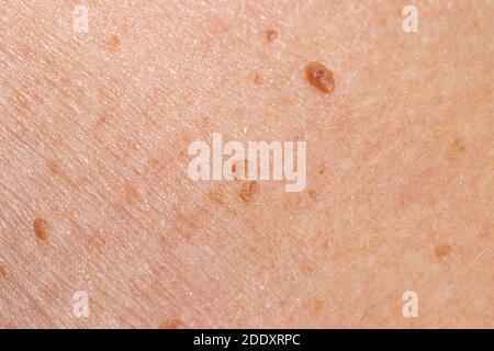 Papillom auf der menschlichen Haut - gutartiger Tumor in Form von Maulwurf, Nevus, Tumor. Papillomatose Stockfoto